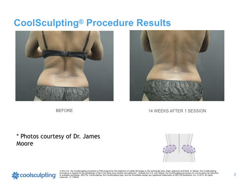 back-Coolsculpting.001