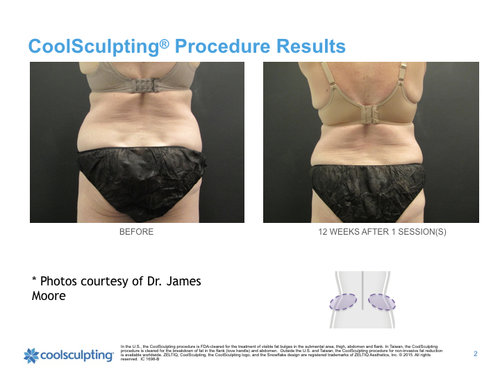 back-woman-flanks-coolsculpting.001