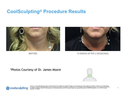 coolsculpting-chin.001