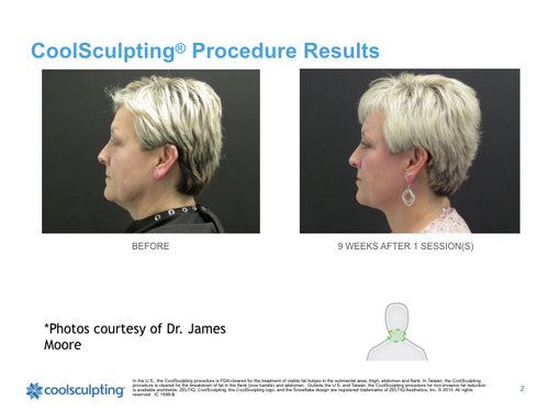 coolsculpting-chin.jpg.001