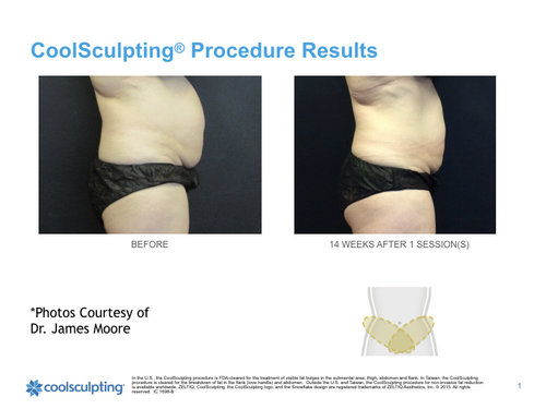 waist-coolsculpting.001