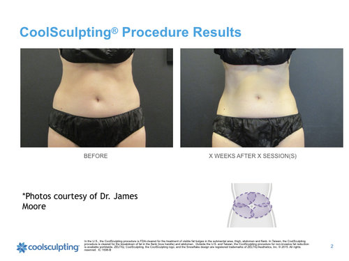 woman-waist-coolsculpting.001